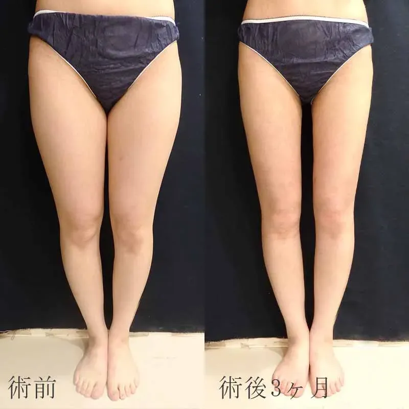 脂肪吸引 | 美容整形なら水の森美容クリニック【公式】