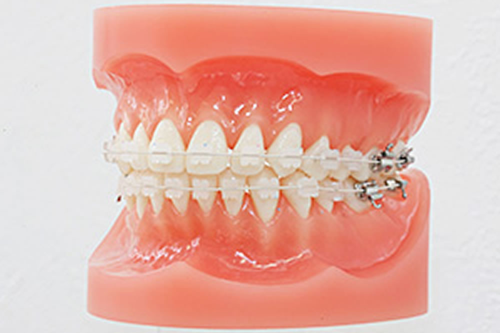 66万円～矯正歯科(マウスピース矯正)札幌市西区西野の村川歯科｜発寒南