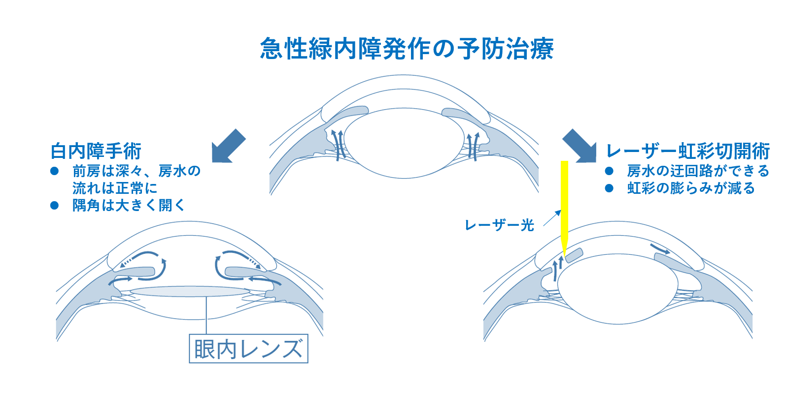 閉塞隅角緑内障：目の良い女性は気を付けて！ - 近視（近眼）や近視