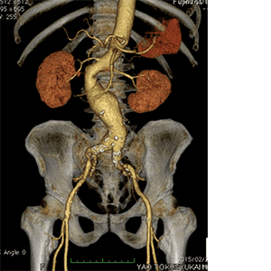大動脈ステントグラフト血管内治療科 | 西宮渡辺心臓脳・血管センター