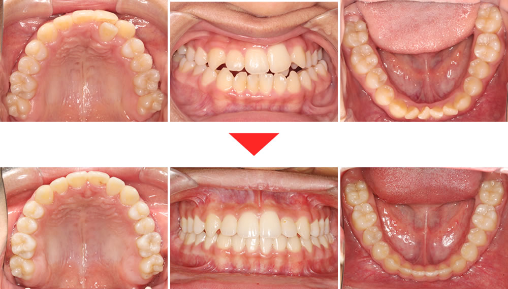 拡大床と拡大アーチによる非抜歯矯正治療の症例 | 銀座6丁目のぶ