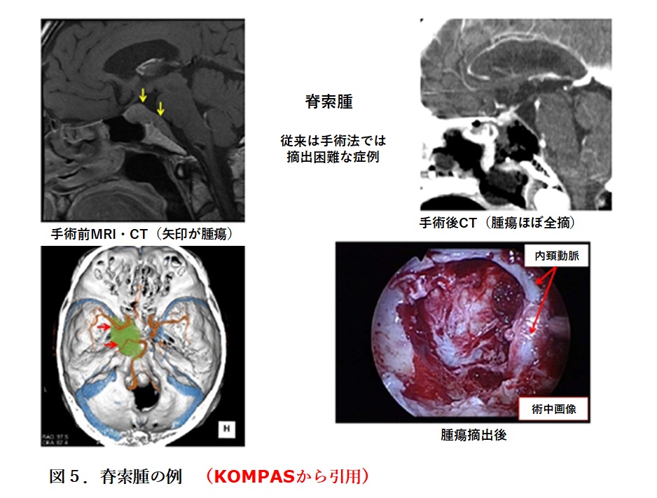 経鼻内視鏡頭蓋底手術| 慶應義塾大学病院脳神経外科教室