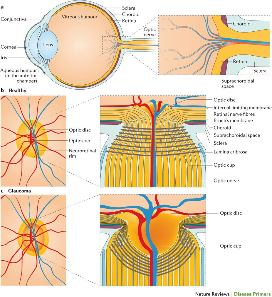 原発開放隅角緑内障 | Nature Reviews Disease Primers | Nature Portfolio