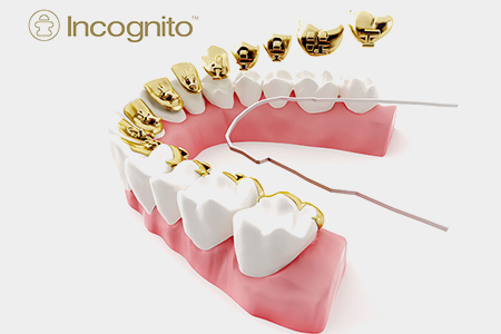 矯正歯科｜中野坂上駅前スワン歯科・矯正歯科