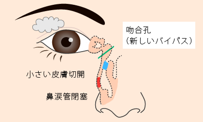 群馬で涙道（なみだ目）治療・手術について | 伊勢崎市 新田眼科