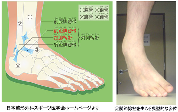 足関節捻挫 | メディカル情報 | 指導者向け情報 | 選手・保護者・指導