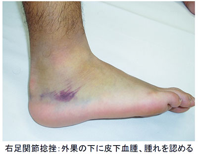 足関節捻挫 | メディカル情報 | 指導者向け情報 | 選手・保護者・指導