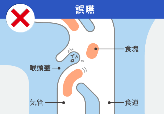 嚥下障害と誤嚥性肺炎［学ぶ＆ケア］ | ニュートリー株式会社
