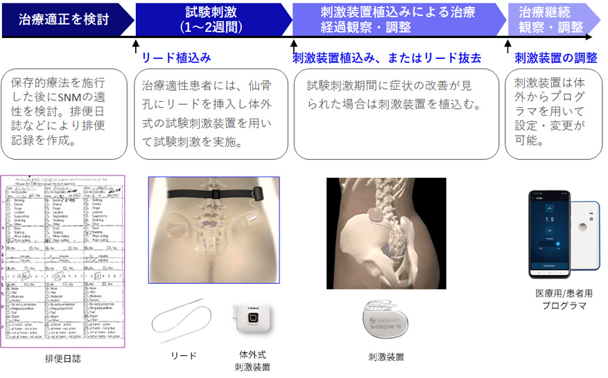 治療の流れ ｜ SNM（仙骨神経刺激療法）の概要 ｜ 日本メドトロニック