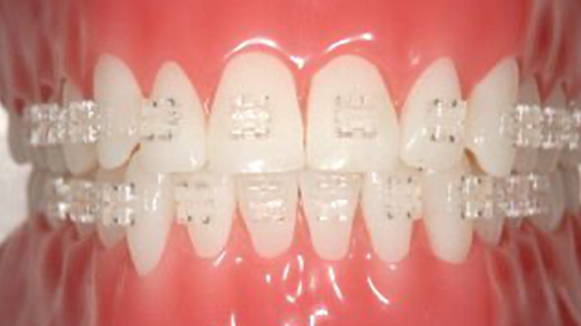 審美ブラケット｜自由が丘の歯医者 自由が丘シーズ歯科・矯正歯科