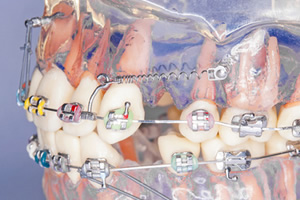 歯科矯正用アンカースクリューを用いた矯正歯科治療 | 高崎市 前橋市