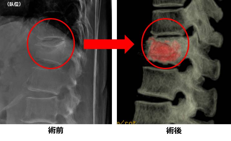 脊椎疾患の診察・治療・手術｜社会福祉法人恩賜財団 済生会滋賀県病院