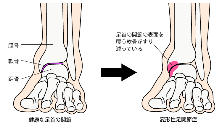 変形性足関節症 (へんけいせいあしかんせつしょう)とは | 済生会