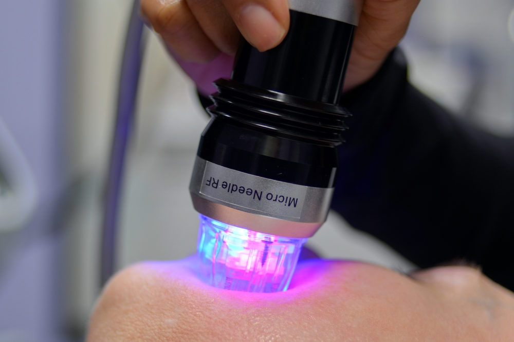 福岡初導入！！サーマニードル(ニードルRF)｜福岡・天神・大名の美容