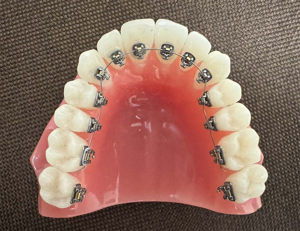 裏側矯正（リンガル矯正）｜三軒茶屋デンタルデザイン歯列矯正歯科