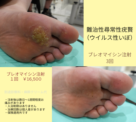 尋常性疣贅（ウイルス性いぼ）ブレオマイシン注射治療 – 南青山 皮膚科