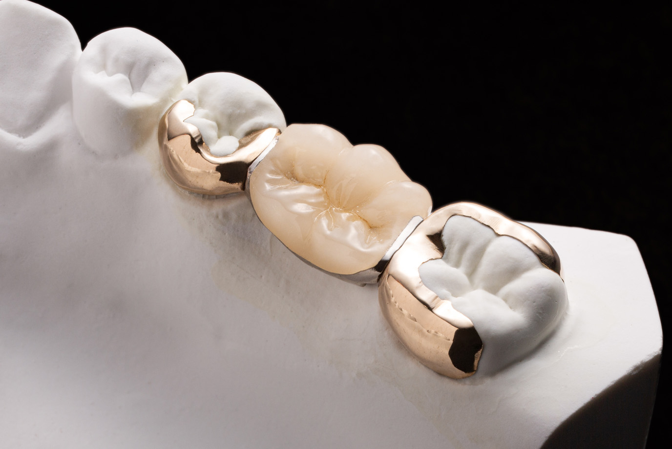 審美補綴物［MIブリッジ］｜株式会社シケン