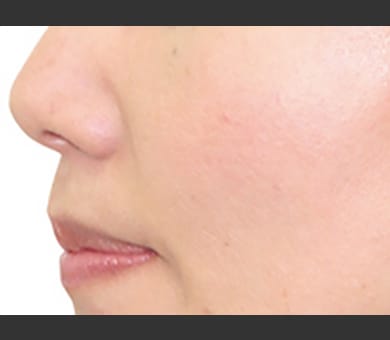 茶色の色素性病変治療にQスイッチルビーレーザー | 美容整形なら品川