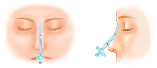 プチ隆鼻（ヒアルロン酸注入） | 隆鼻術・鼻の整形なら城本クリニック