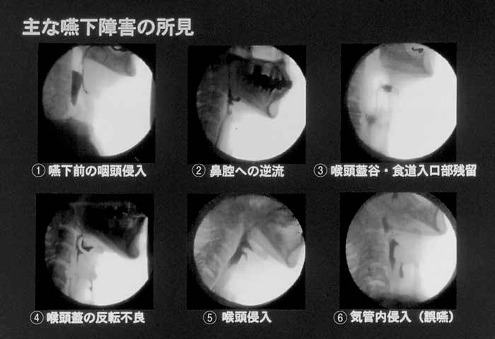 Ⅰ-2.嚥下障害治療におけるPEGの位置付け｜摂食・嚥下障害と胃瘻｜PDN通信