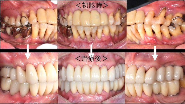 症例】歯周病に対するインプラント治療｜港南台パーク歯科クリニック