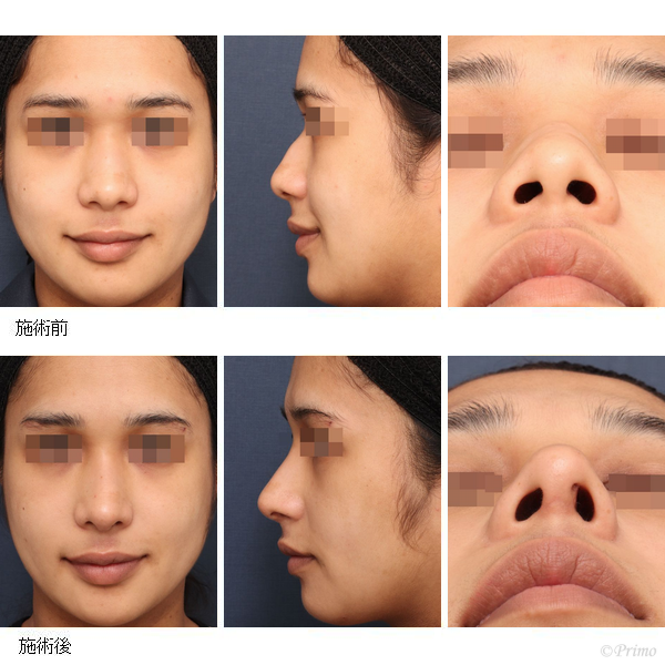 F 鼻中隔矯正術＋鼻中隔延長術＋鼻尖形成術＋隆鼻術＋整鼻術＋眉間