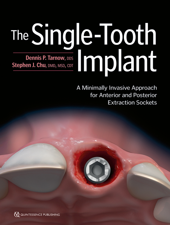 The Single-Tooth Implant | Dennis P. Tarnow / Stephen J. Chu
