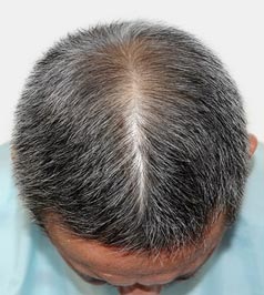 抜け毛・薄毛対策 発毛実感プラン｜リーブ21の体験プラン