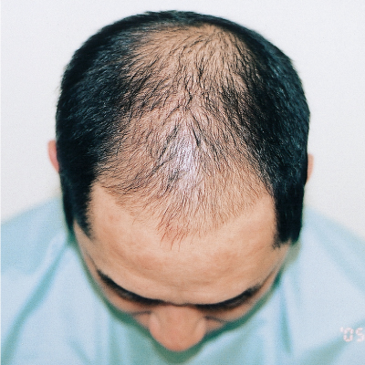 脱毛タイプの基礎知識｜薄毛改善・発毛専門のリーブ21【公式】