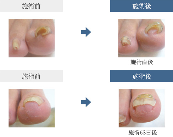 巻き爪矯正インベントプラス｜巻き爪矯正・フットケア器具製造・販売