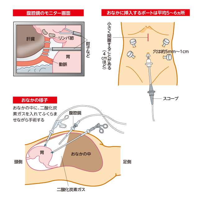 8.外科手術 腹腔鏡下手術 ―腹腔鏡下手術ってどんな手術？―｜胃癌と診断