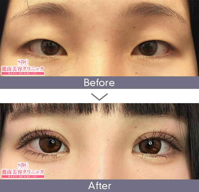 週末二重®｜二重・目元整形なら湘南美容クリニック【公式】