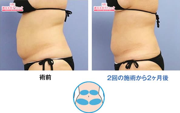 クールスカルプティング® エリート（クルスカダブル）｜リバウンドなし