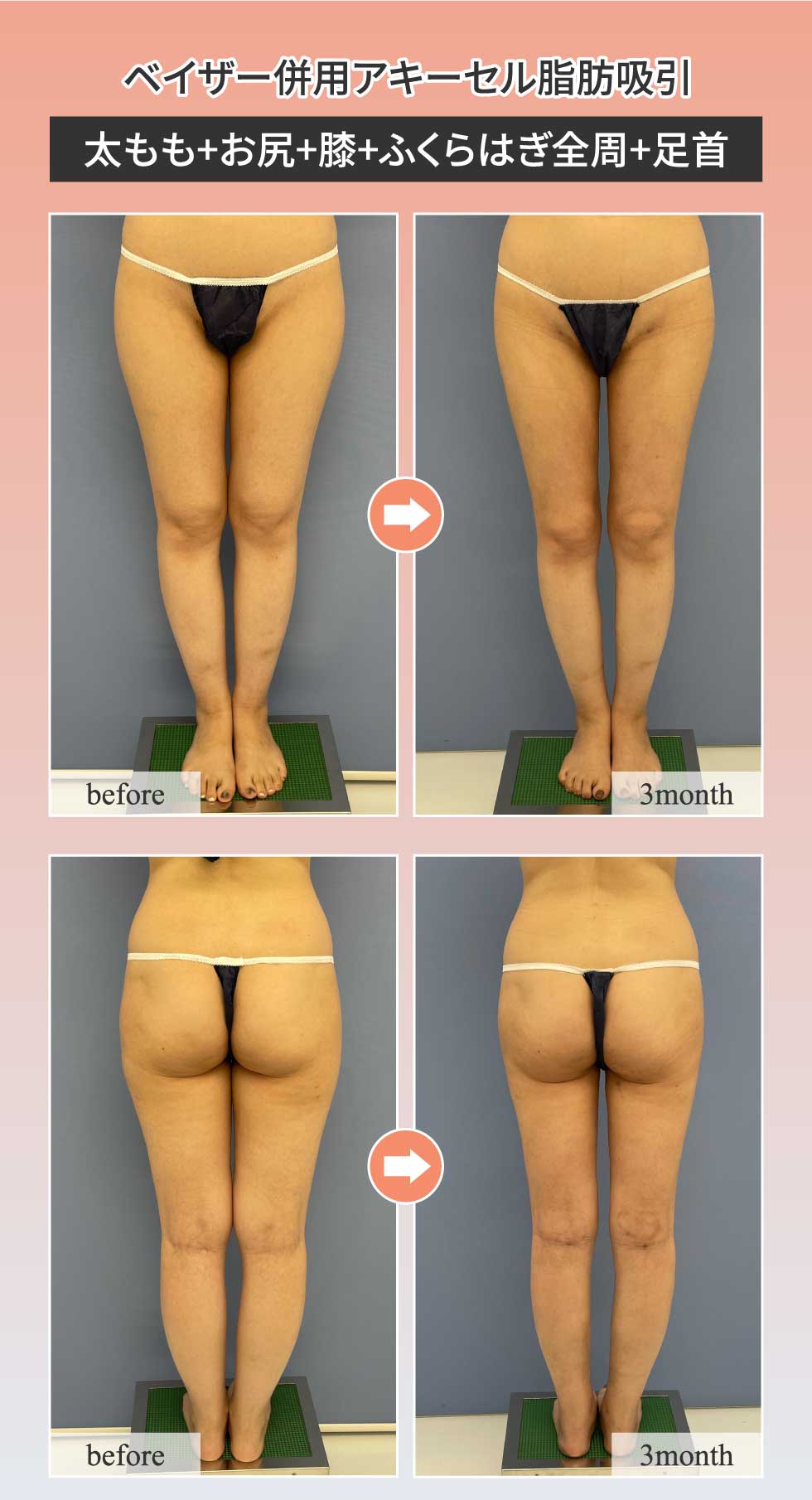 脚の脂肪吸引なら脂肪吸引の名医・くずしま先生にお任せください