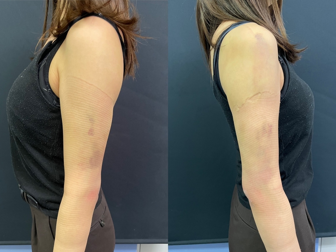 脂肪吸引のダウンタイム・圧迫・早く治す過ごし方【写真あり】 - 横浜院