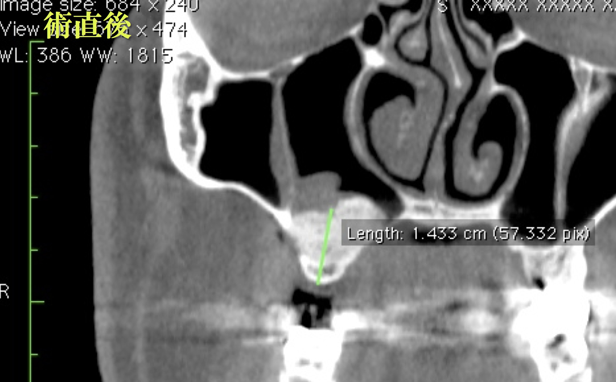 上顎洞底挙上術（サイナスリフト）について｜元町歯科診療所のコラム