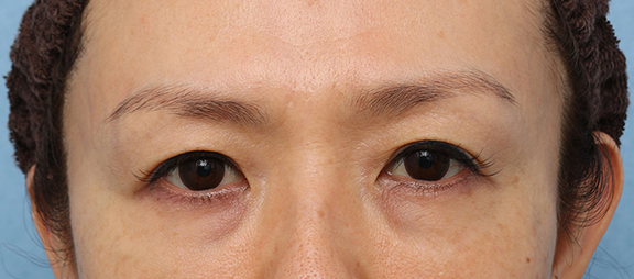 症例写真】サーマクールアイFLXの症例 まぶたのタルミが気になり始めた