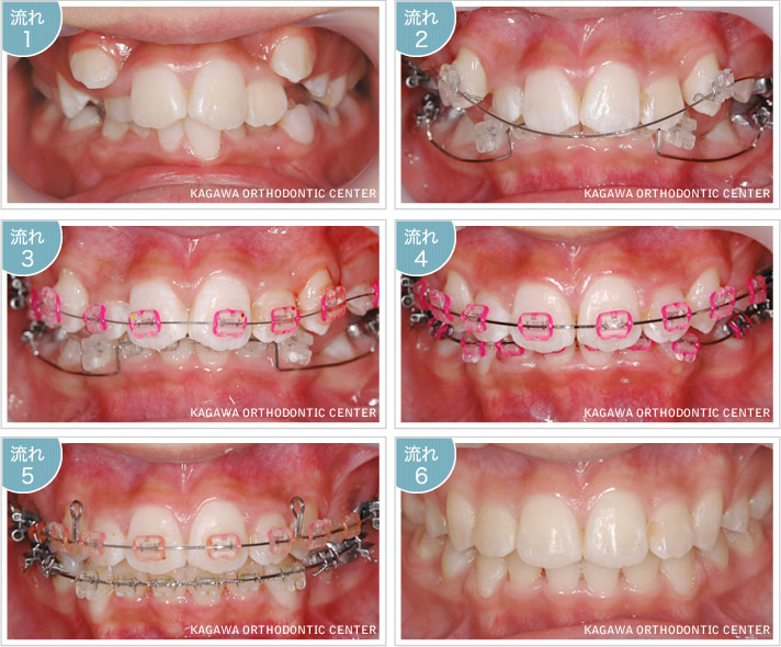 小児矯正における早期治療の意味 | は世界水準の治療を行います