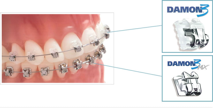 香川県の成人矯正治療はたくま歯科医院まで