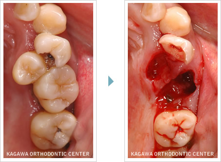 は世界水準の治療です|歯周病との関係