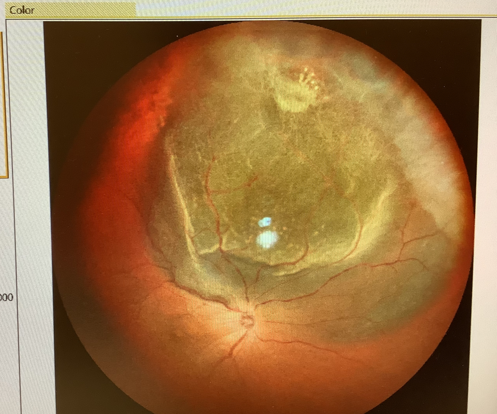 硝子体手術後の網膜剥離 - たまプラーザやまぐち眼科