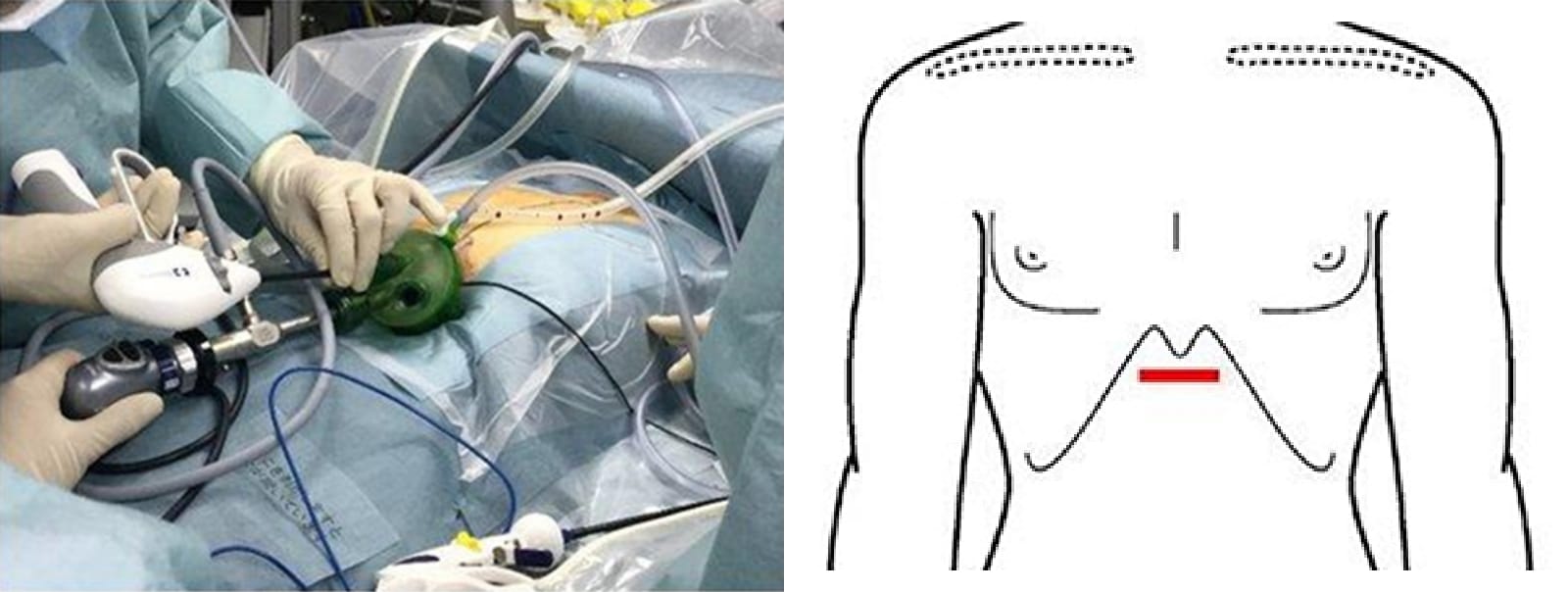 縦隔腫瘍に対する胸腔鏡下手術｜社会医療法人三栄会 ツカザキ病院