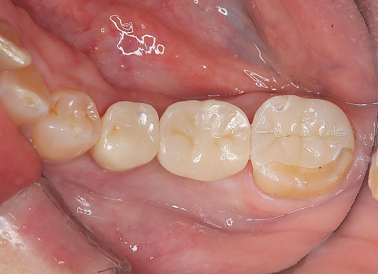 30代】「歯がボロボロ」を治したい方へ - 池袋駅の歯医者なら池袋駅