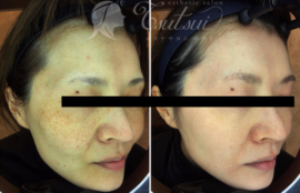 ゼオスキン＊ミラミンとミラミックスはどう違うの？正しい使い方・裏技