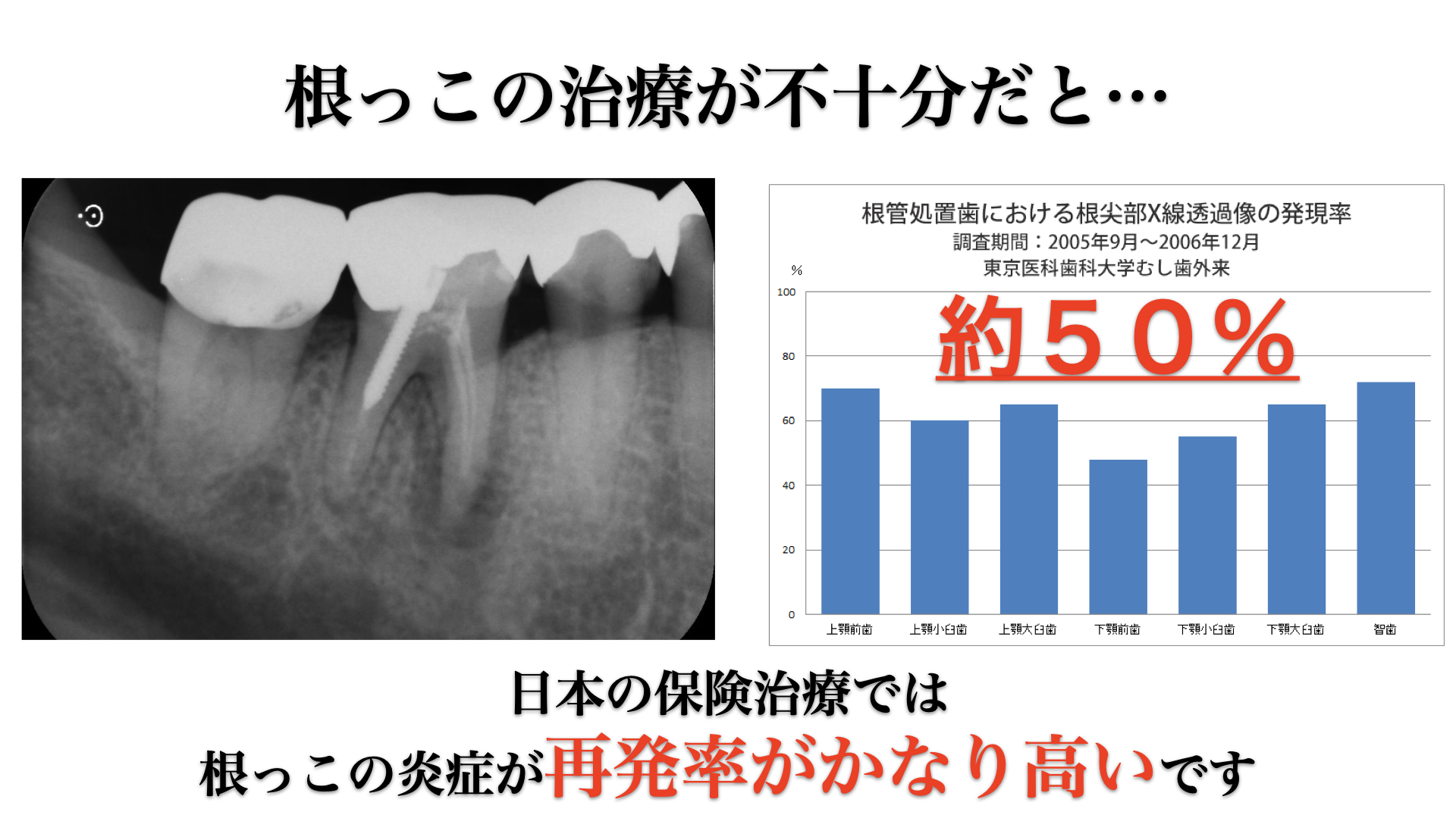 ラバーダムを使用した根管治療は成功率を高める
