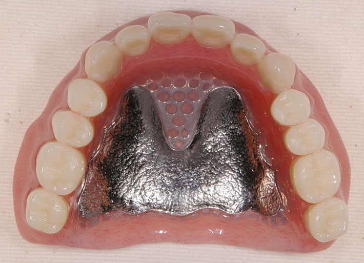 自費の義歯・入れ歯 / 大田区 大森駅前 歯医者さん「内田歯科医院