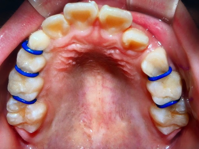 顎顔面矯正〜パート2〜 - うえだ歯科クリニック|箕面市の歯医者・歯科