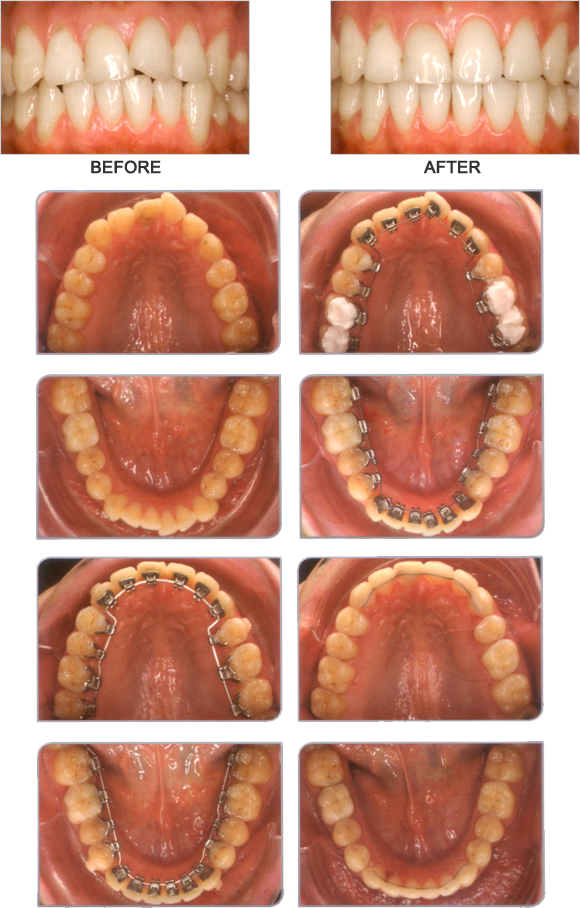 神戸 舌側矯正ハーモニー｜神戸市灘区 うしじま歯科・矯正歯科クリニック