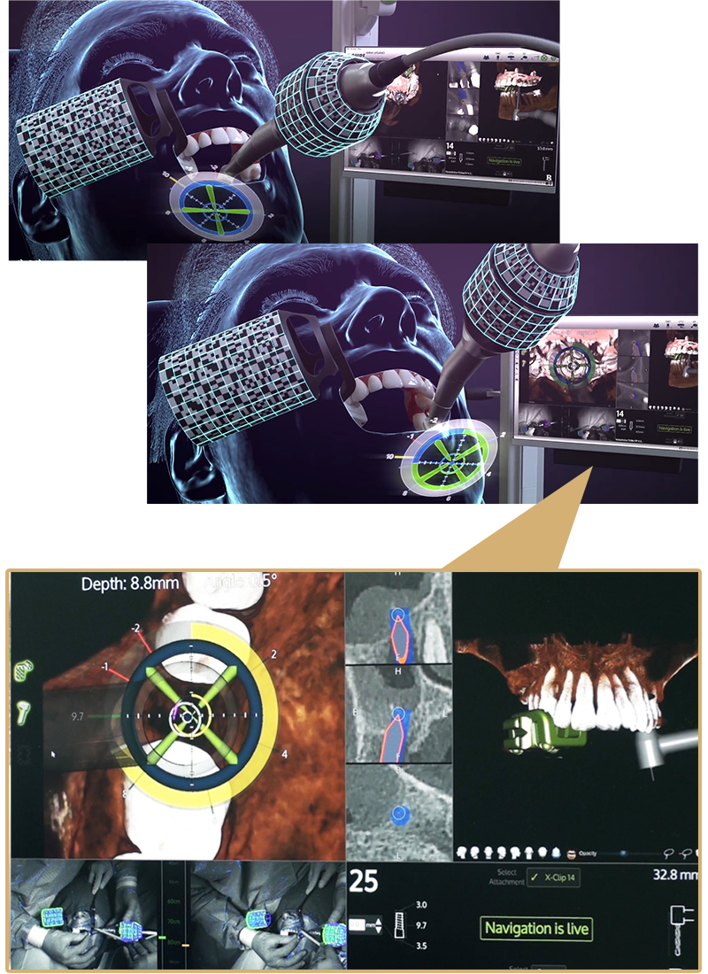 神戸でインプラントなら神戸市灘区うしじま歯科クリニックへ｜X-ガイド