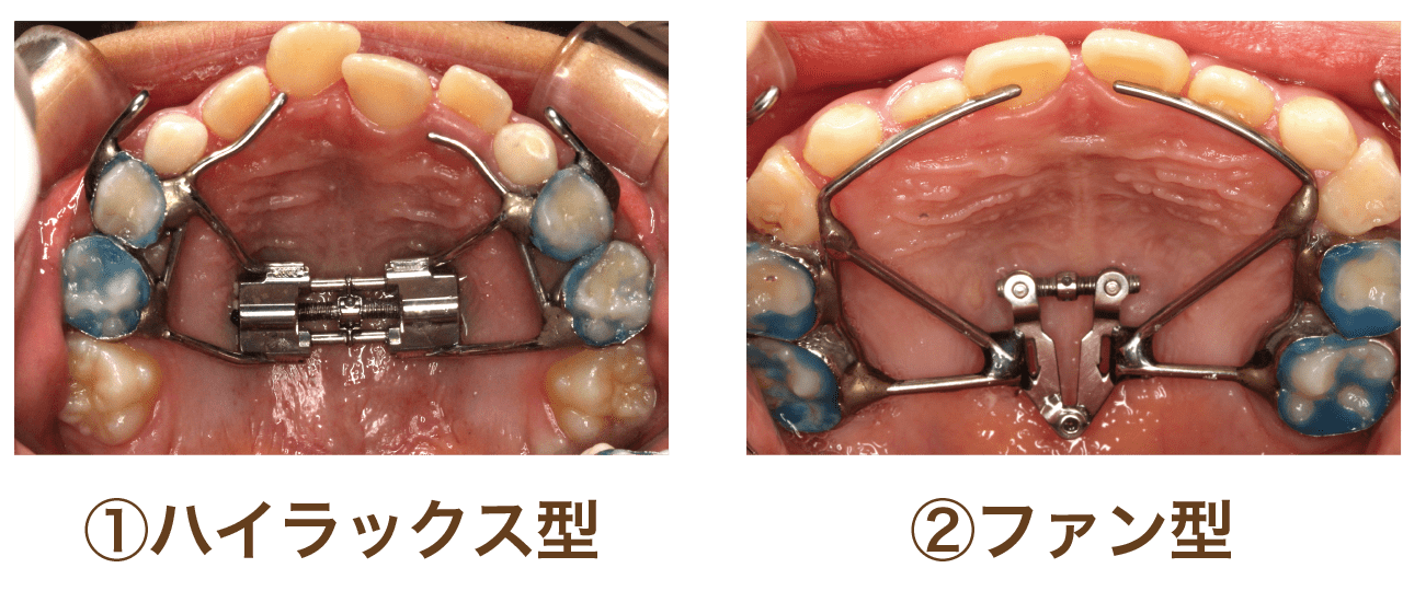 矯正歯科 こども顎顔面矯正 - 装置の種類について | 武庫之荘 井上歯科